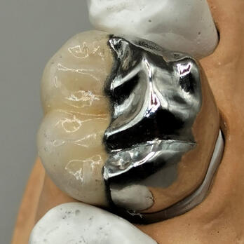 Puente meryland metálico sobre modelo dental