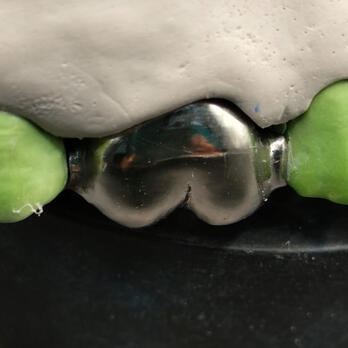 Puente meryland metálico sobre modelo dental